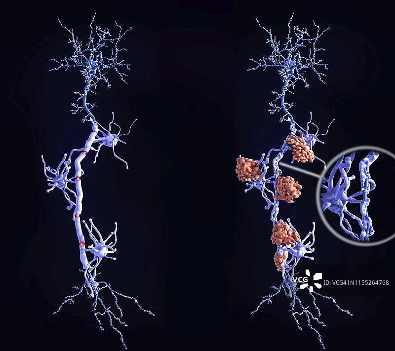 多发性硬化症中的健康神经元与神经损伤图片素材