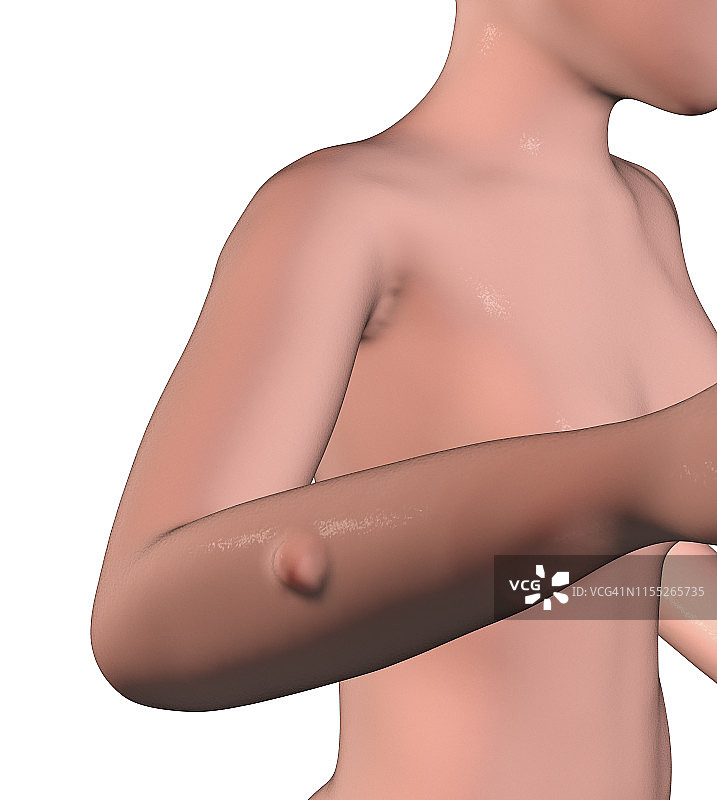 脂肪瘤插图图片素材