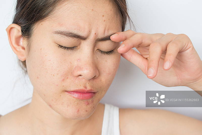 年轻亚裔女性面部痤疮红肿问题，焦虑有压力图片素材