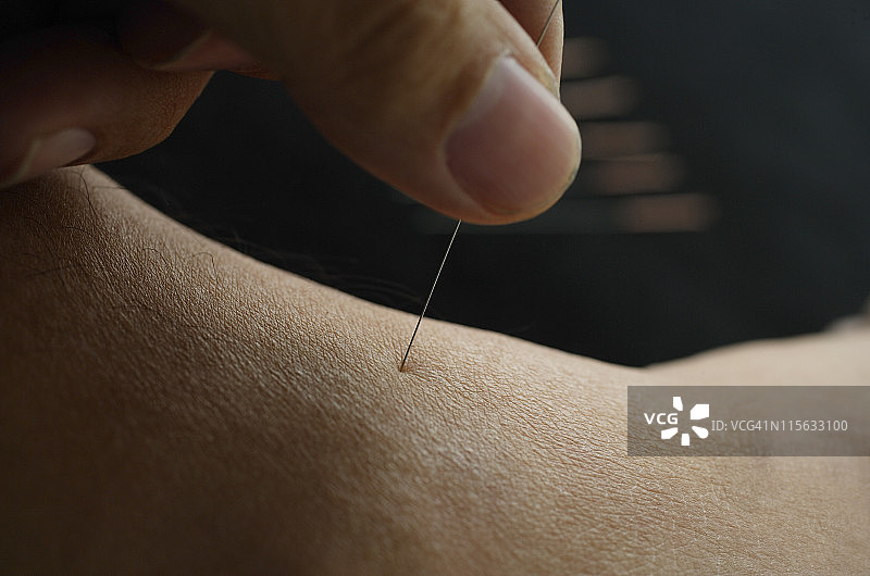 针灸针刺入图片素材