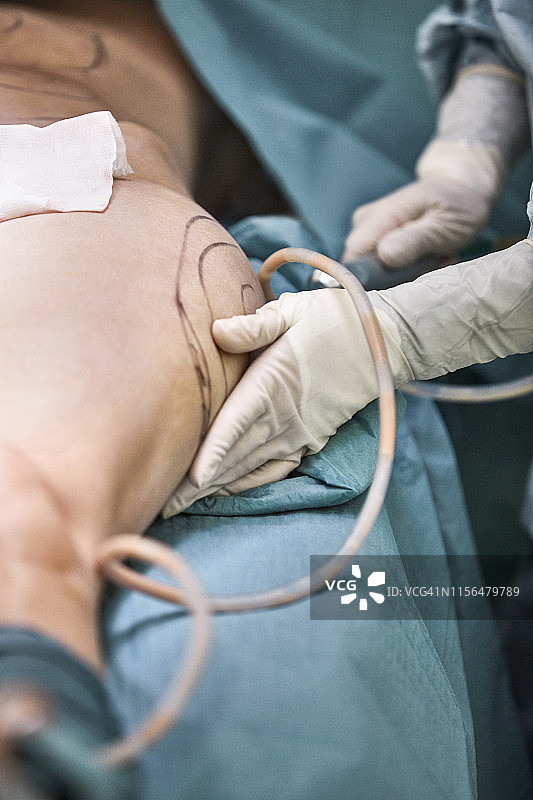 外科医生在病人腿上拿着吸管图片素材