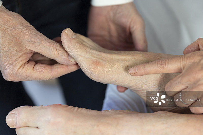 拇外翻图片素材