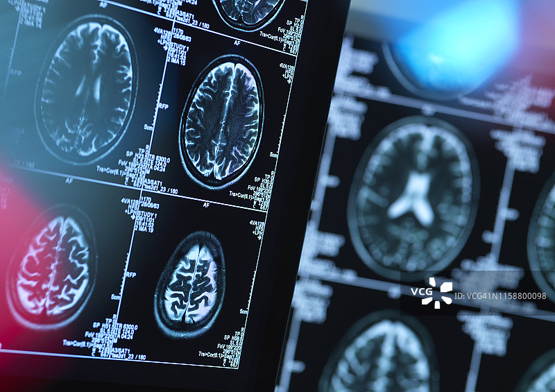 诊所中可能患病或受损的大脑扫描图片素材
