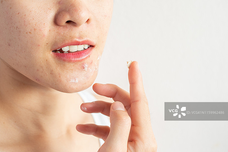 女人使用祛痘霜解决面部炎症（丘疹和脓疱）图片素材