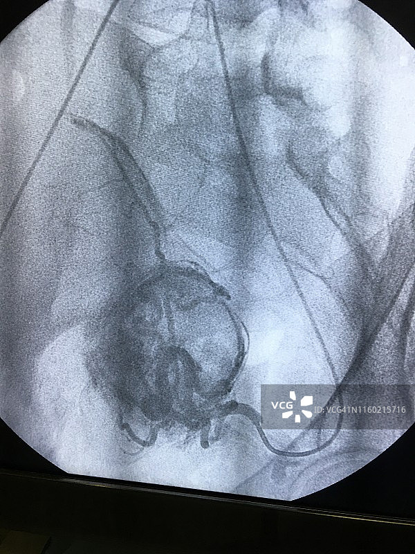 子宫肌瘤的X光片图片素材