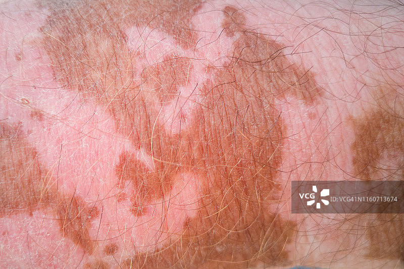 患有白癜风的男人的手图片素材