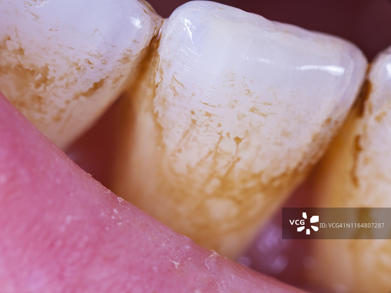 牙菌斑图片素材