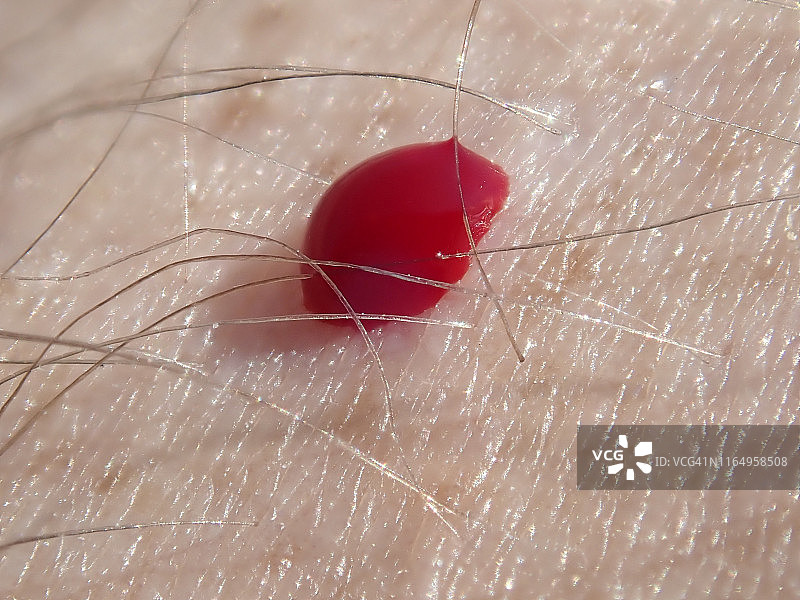 绿头苍蝇叮咬人的皮肤图片素材