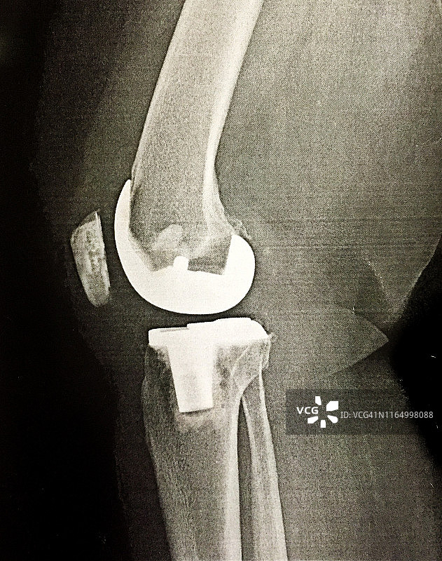 全膝关节置换术后的人类膝盖图片素材