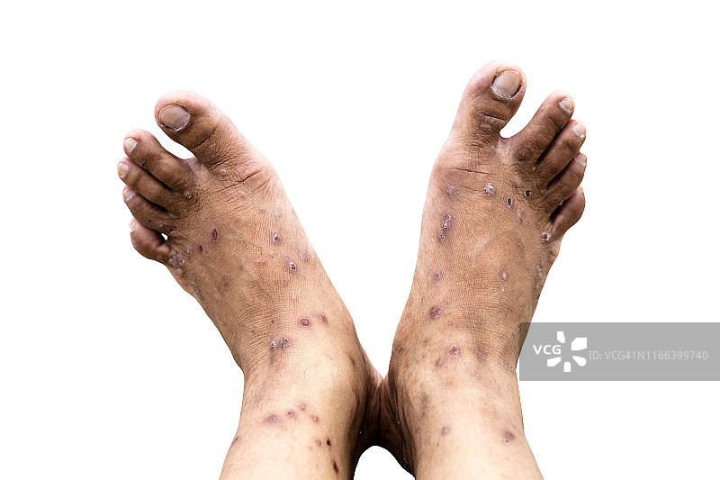 皮肤过敏：皮疹引起的皮炎问题，过敏性皮疹和健康问题图片素材