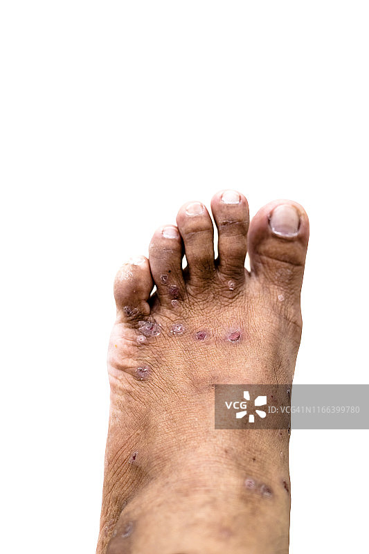 皮肤过敏：皮疹引起的皮炎问题，过敏性皮疹和健康问题图片素材