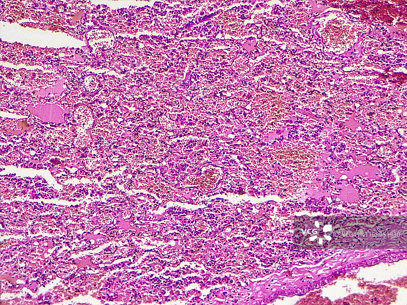 肺出血性梗死，10倍光学显微照片图片素材