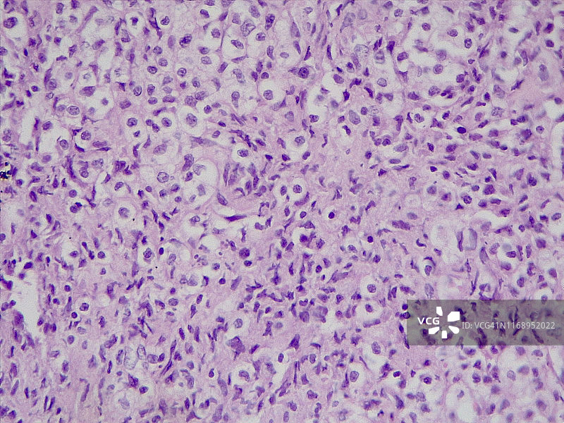 恶性淋巴瘤，40倍光学显微照片图片素材
