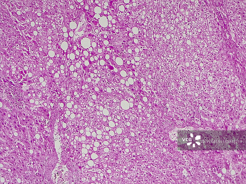 肝脏脂肪变性10倍光学显微照片图片素材