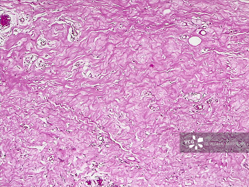 结缔组织透明变性，10倍光学显微照片图片素材
