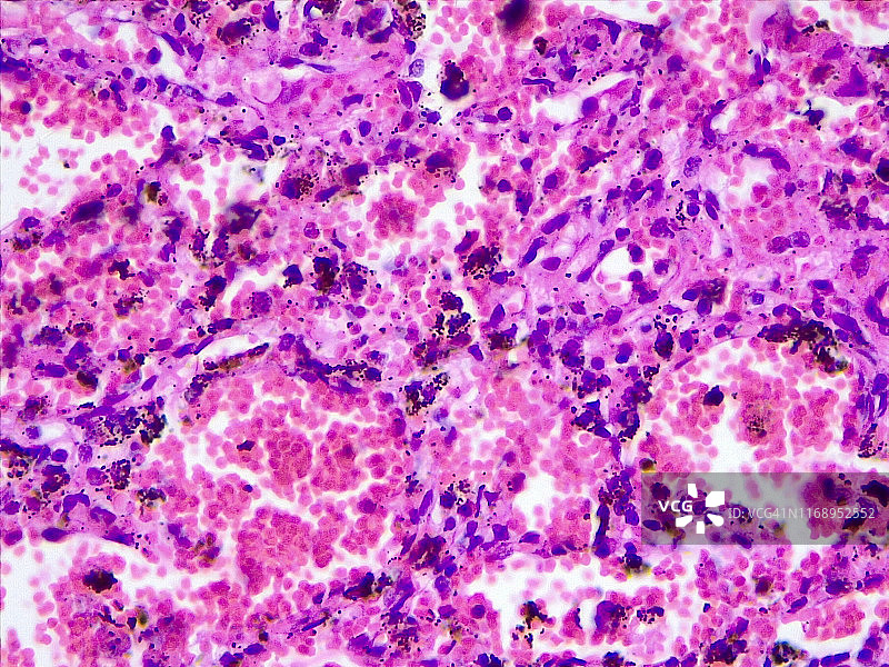 慢性肺充血40倍光学显微照片图片素材