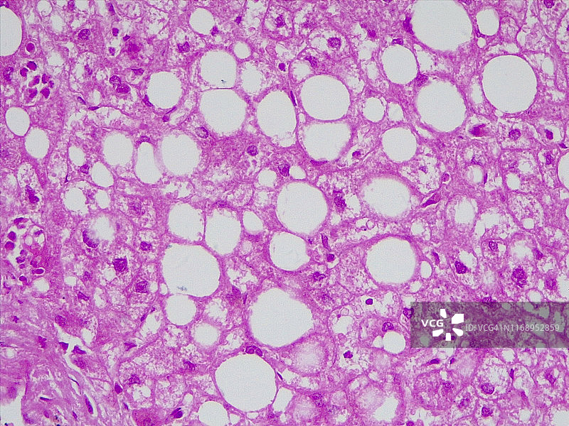 肝脏脂肪变性，40倍光学显微照片图片素材