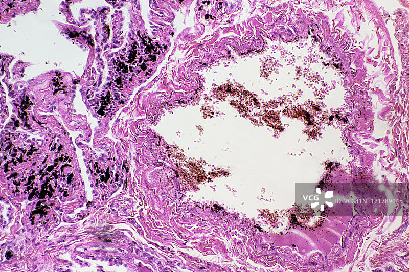 黑肺病（炭末沉着病），含煤尘的肺组织和细支气管100倍图片素材