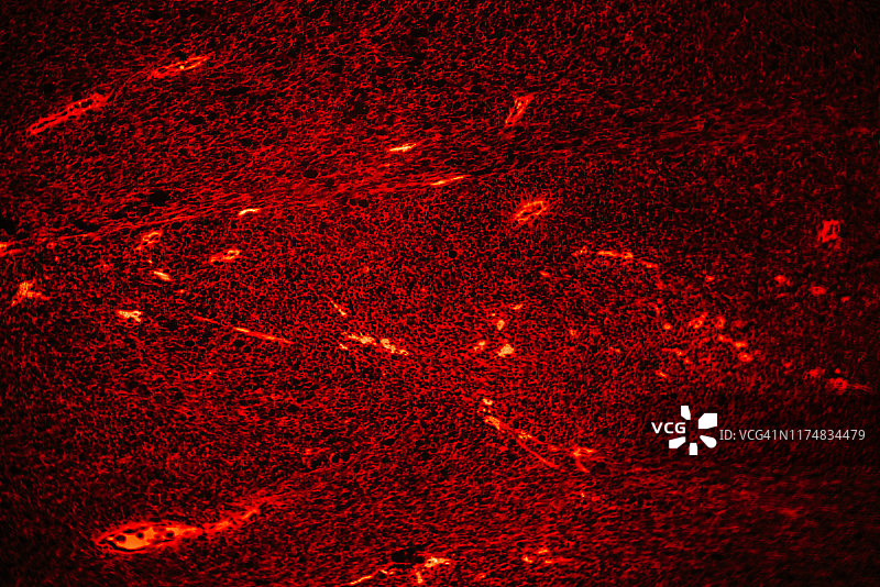 医学人体癌细胞纤维肉瘤图片素材