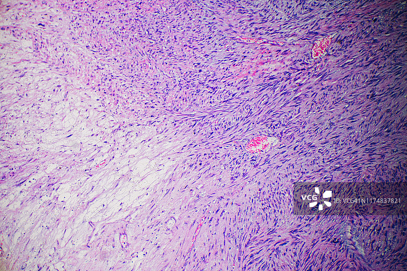 人肿瘤组织的平滑肌肉瘤癌细胞图片素材