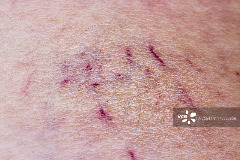 健康概念：女性的静脉曲张特写图片素材