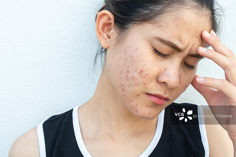因脸上粉刺炎症（丘疹和脓疱）问题而情绪低落的压力女性肖像图片素材