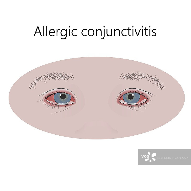 过敏性结膜炎，插图图片素材