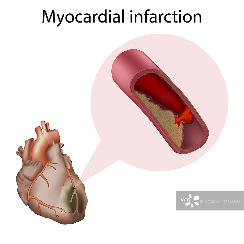 心肌梗死，图示图片素材