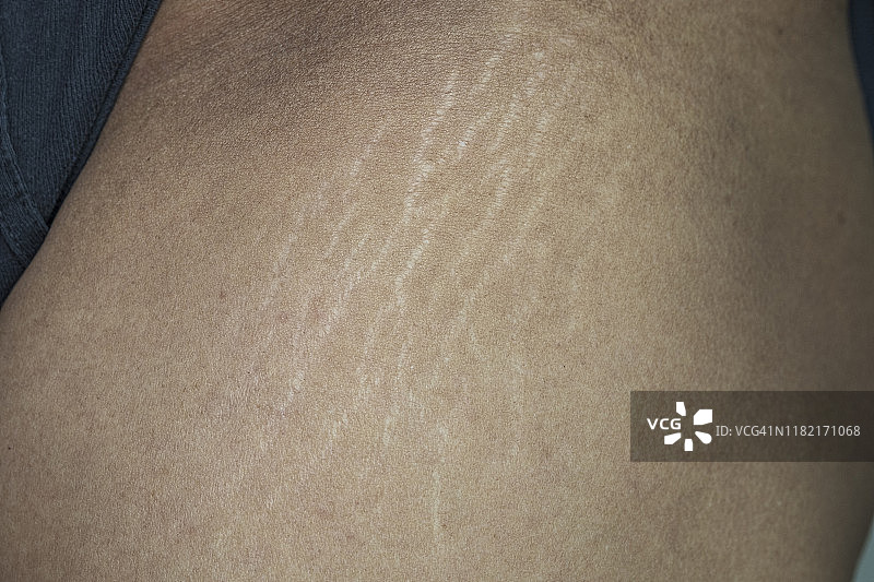 男人腿部的生长纹图片素材