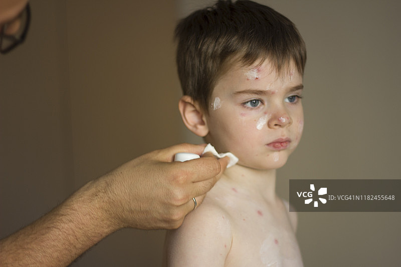 治疗水痘图片素材