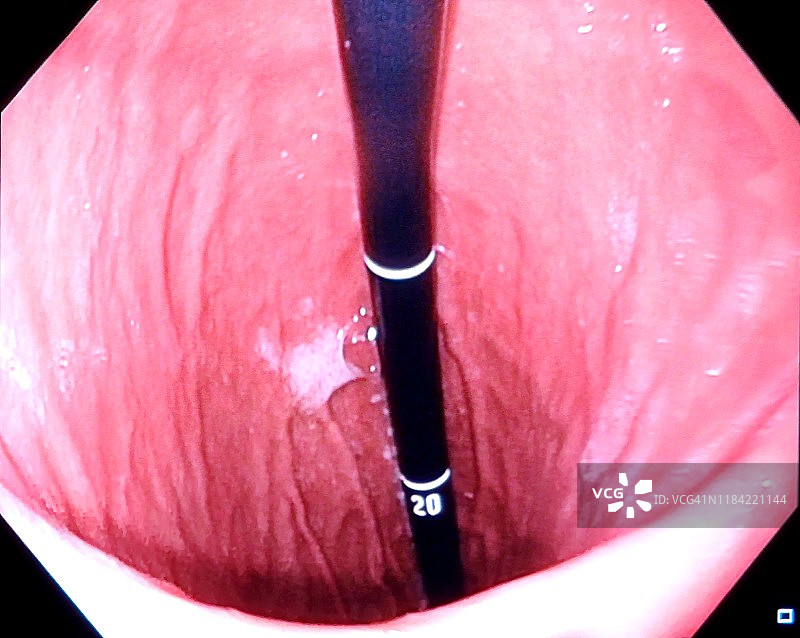 消化内镜检查图片素材