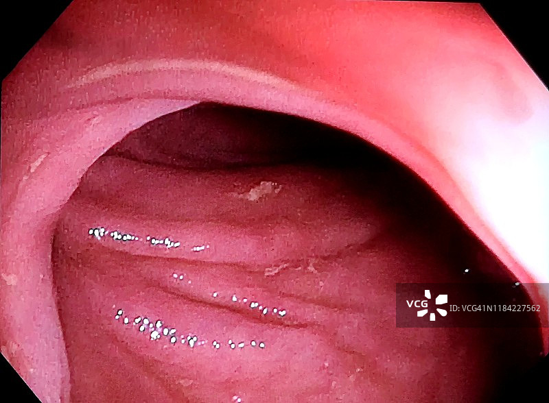结肠镜检查图片素材
