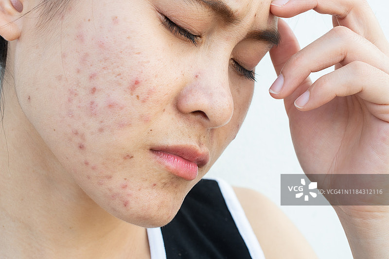 因脸上粉刺炎症（丘疹和脓疱）问题而情绪低落的压力女性肖像图片素材