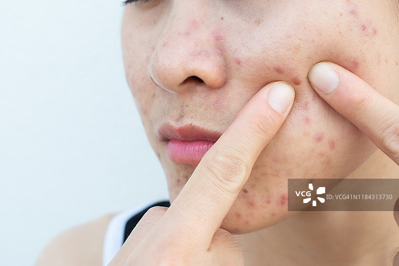 亚洲女性试图挤压脸颊上红肿痘痘的局部特写镜头图片素材