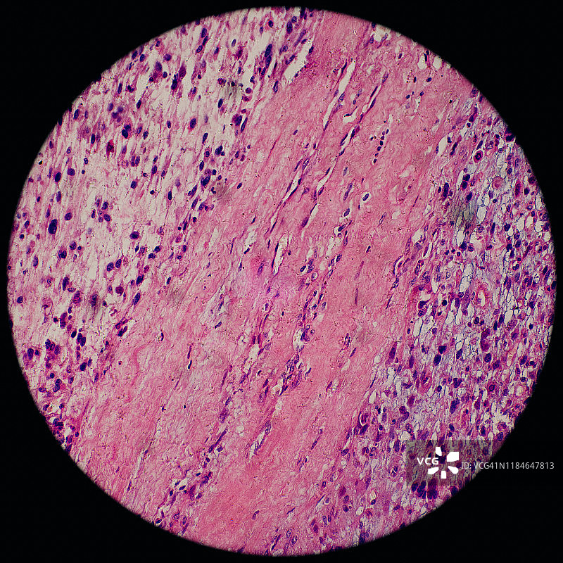 显微镜下的人体骨骼肌肿瘤细胞图片素材