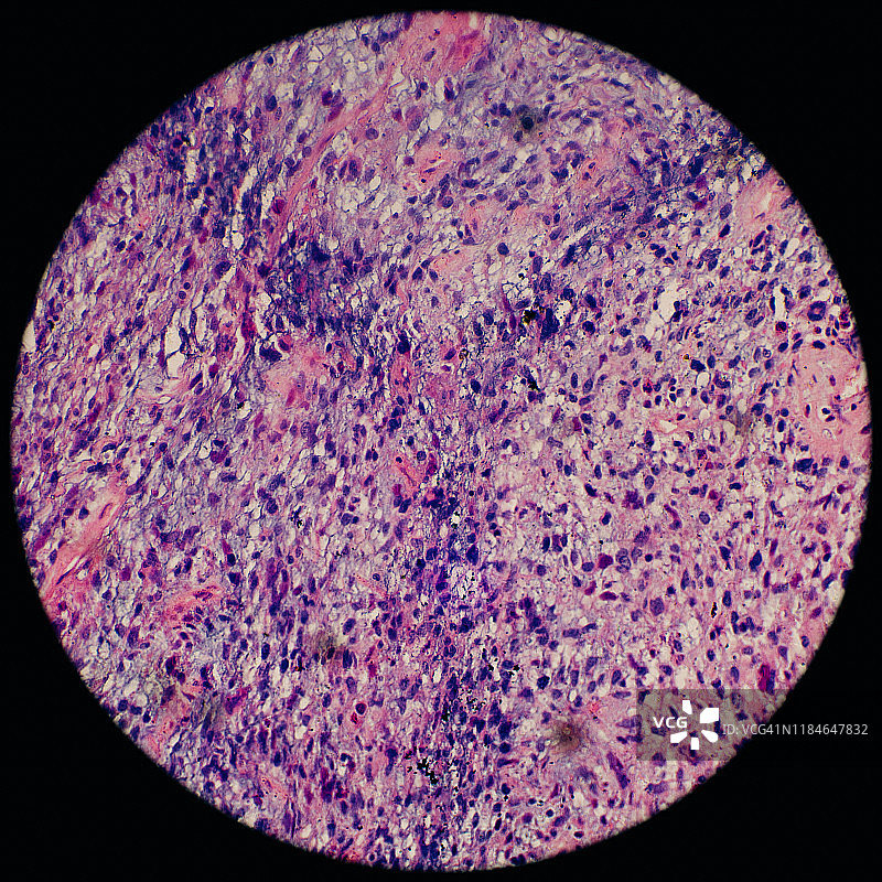 显微镜下的人体骨骼肌肿瘤细胞图片素材