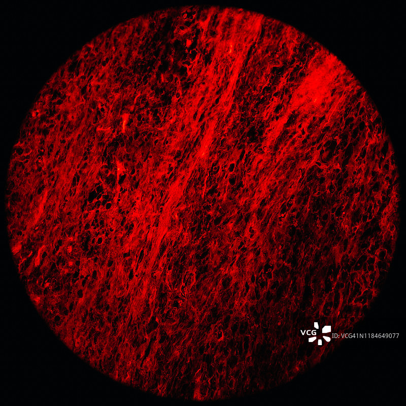 显微镜下的骨骼肌肉肿瘤细胞图片素材