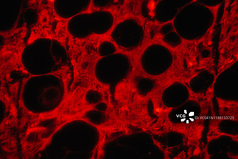 脂肪肉瘤的红色荧光显微照片图片素材