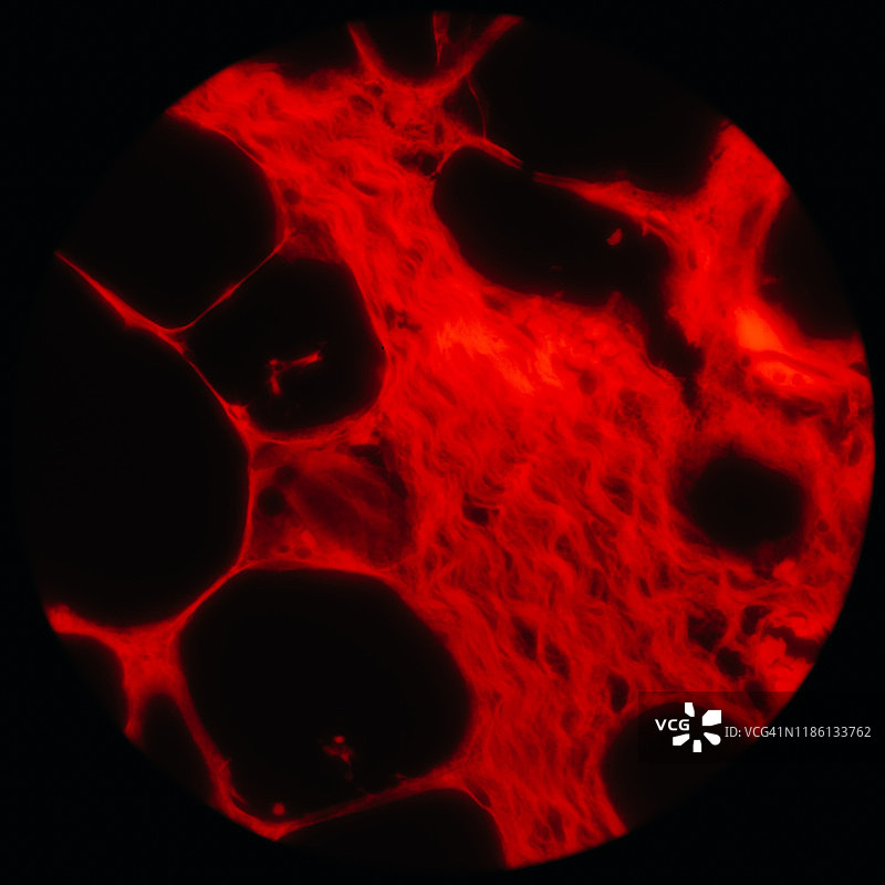 显微镜下的人体脂肪肉瘤癌细胞图片素材