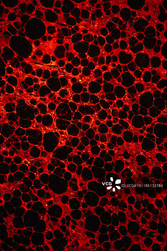 脂肪肉瘤癌细胞医学图图片素材
