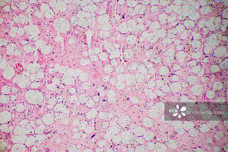 人类脂肪肉瘤细胞的显微照片图片素材