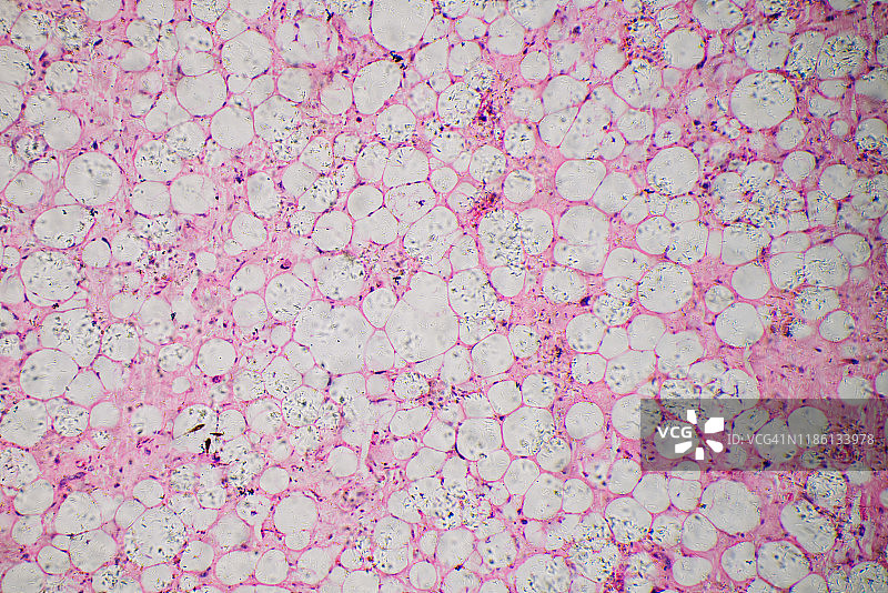 人类脂肪肉瘤细胞的显微照片图片素材