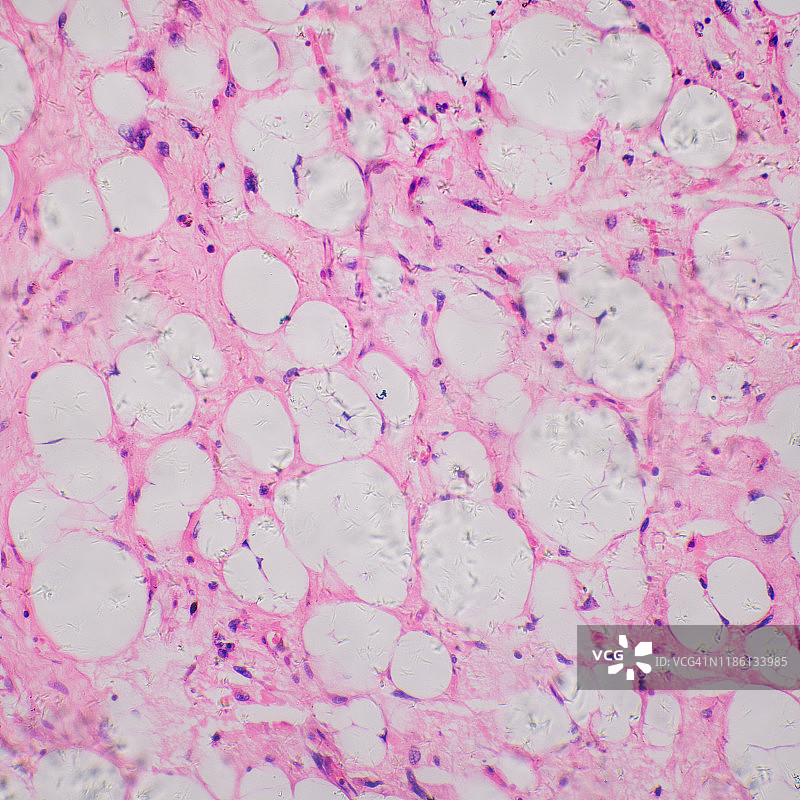 人类脂肪肉瘤细胞的显微照片图片素材