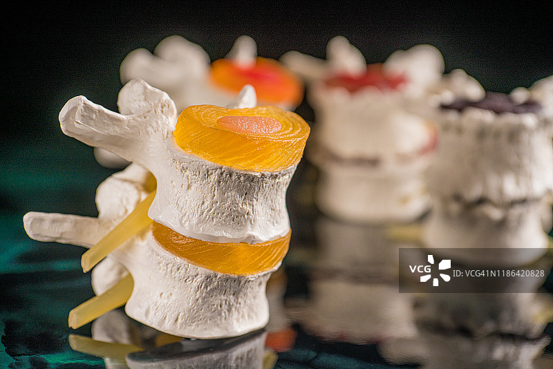 椎骨和椎间盘神经退行性疾病图片素材