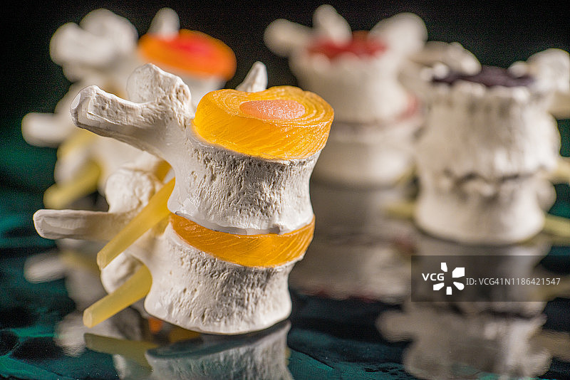 椎骨和椎间盘神经退行性疾病图片素材