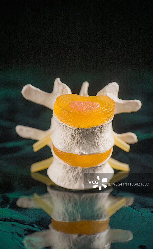 椎骨和椎间盘神经退行性疾病图片素材