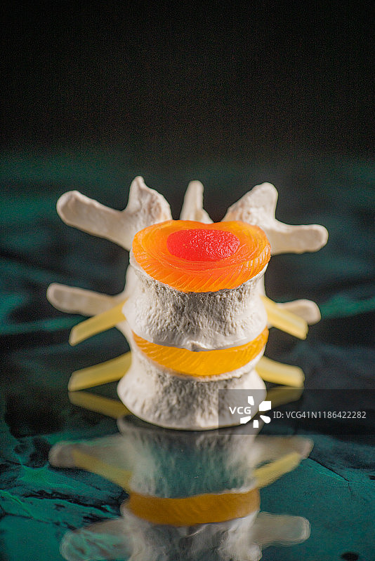 椎骨和椎间盘神经退行性疾病图片素材