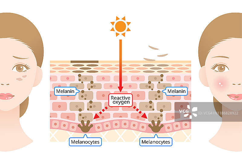 黑色素和面部黑斑的人体皮肤机制。皮肤层信息图。美容和皮肤护理概念图片素材