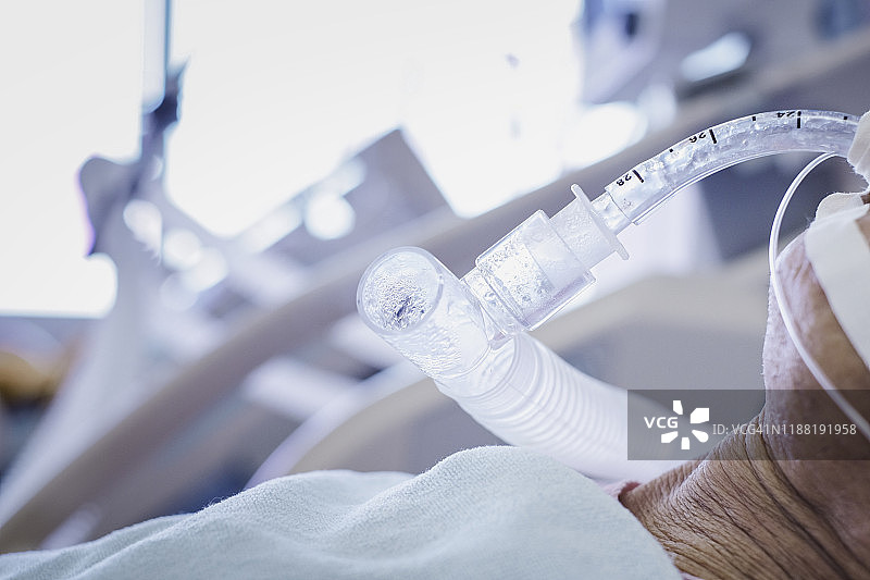从气管插管断奶，给人体供氧图片素材