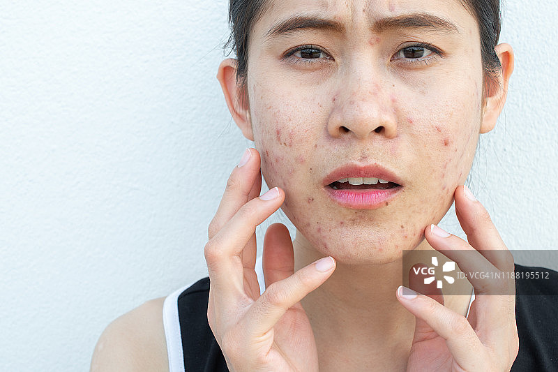 面部有痤疮炎症（丘疹和脓疱）问题的焦虑的女人肖像图片素材